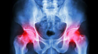 What Assistive Technology Helps with Hip Dysplasia?