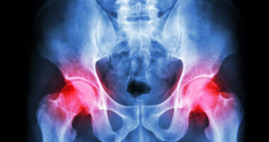 What Assistive Technology Helps with Hip Dysplasia?